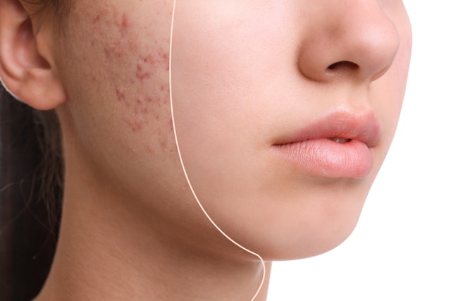 How to remove acne scars home remedies