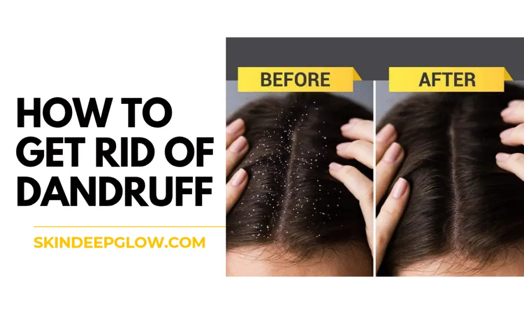 how to get rid of dandruff in Hindi