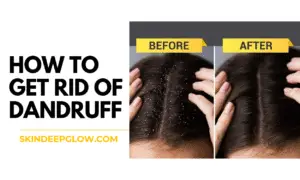 Read more about the article How to Get Rid of Dandruff in Hindi: रूसी से छुटकारा पाने के amazing घरेलू उपाय (2025)