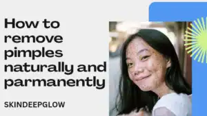 Read more about the article How to Remove Pimples Naturally and Permanently! पिंपल्स हटाने के घरेलू असरदार उपाय (2025)