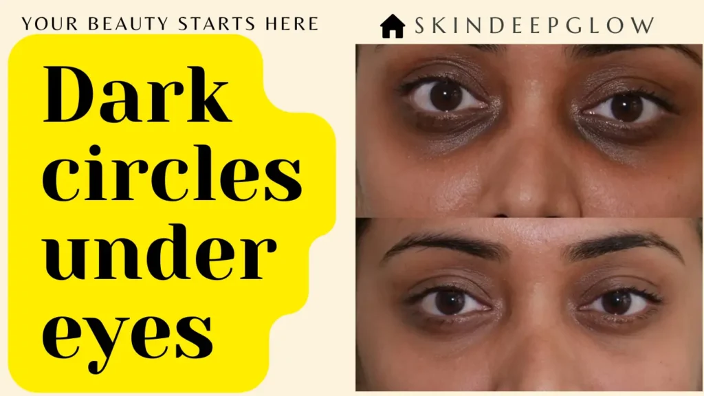 डार्क सर्कल