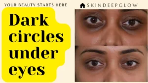 Read more about the article डार्क सर्कल्स क्यों होते हैं? 9 बड़े कारण और 25 proven घरेलू उपाय जो आंखों को फिर से फ्रेश बनाएं