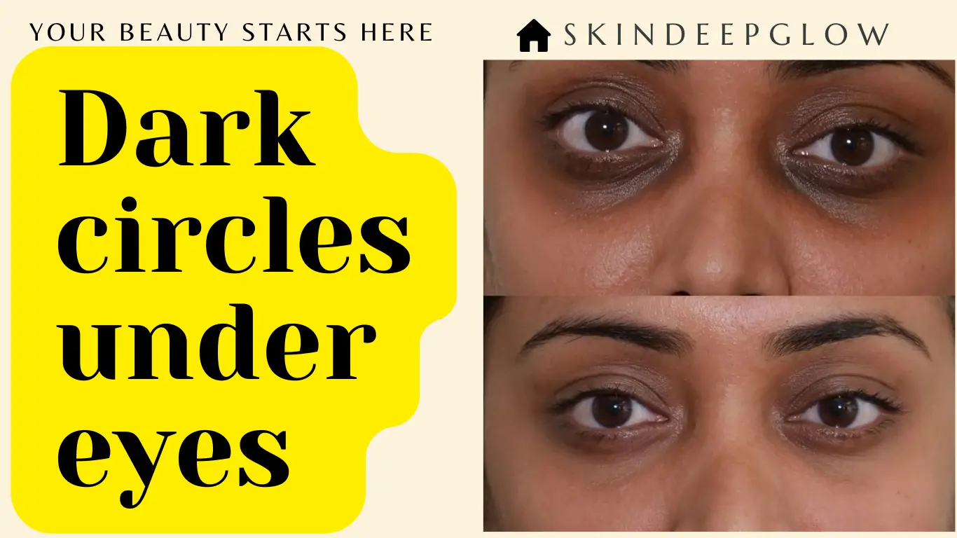 Read more about the article डार्क सर्कल्स क्यों होते हैं? 9 बड़े कारण और 25 proven घरेलू उपाय जो आंखों को फिर से फ्रेश बनाएं