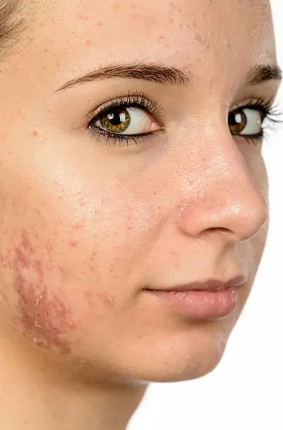 चेहरे पर एक्ने और पिंपल की समस्या दिखाते हुए स्किन केयर ट्रीटमेंट
