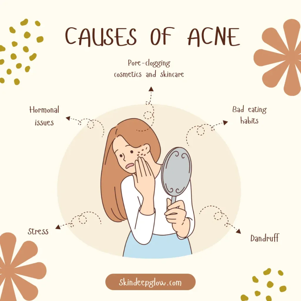Causes of acne