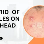 Get rid of pimples on forehead fast