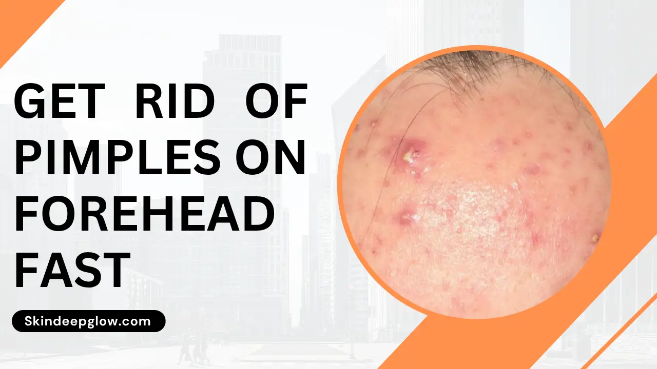 Get rid of pimples on forehead fast