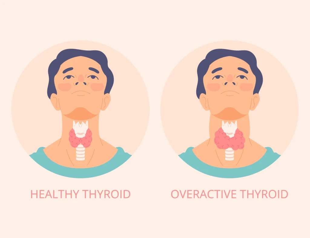 Healthy vs overactive thyroid