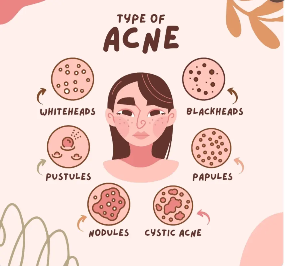 Types of pimples
