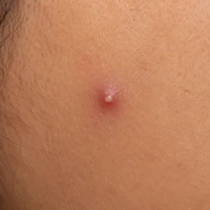 पिंपल कैसे हटाए: घरेलू उपाय, Skincare Routine, Diet और वो 5 Secret Remedies जो कोई नहीं बताता 5 Close-up of a pustule acne pimple with white tip on medium Indian skin tone