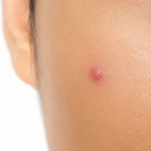 पिंपल कैसे हटाए: घरेलू उपाय, Skincare Routine, Diet और वो 5 Secret Remedies जो कोई नहीं बताता 4 Close-up of a small red papule pimple on Indian skin tone with mild inflammation