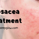 Rosacea Treatment