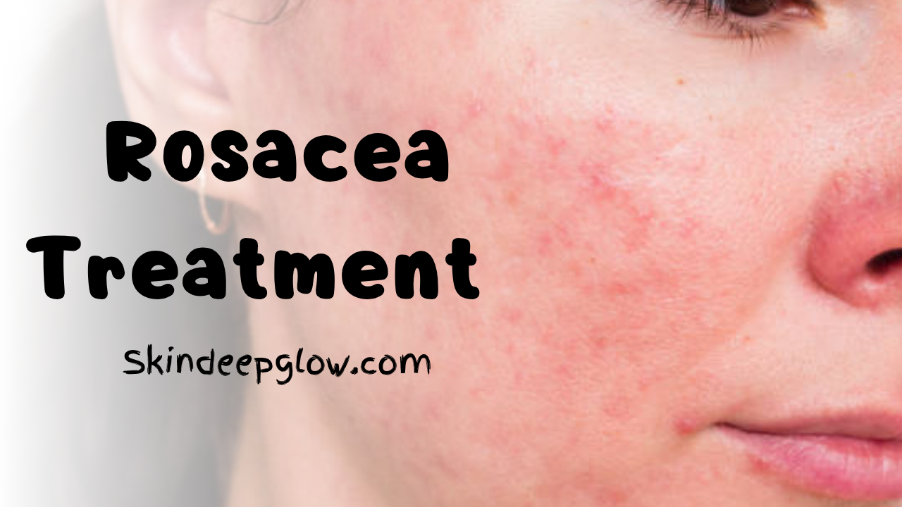 Rosacea Treatment