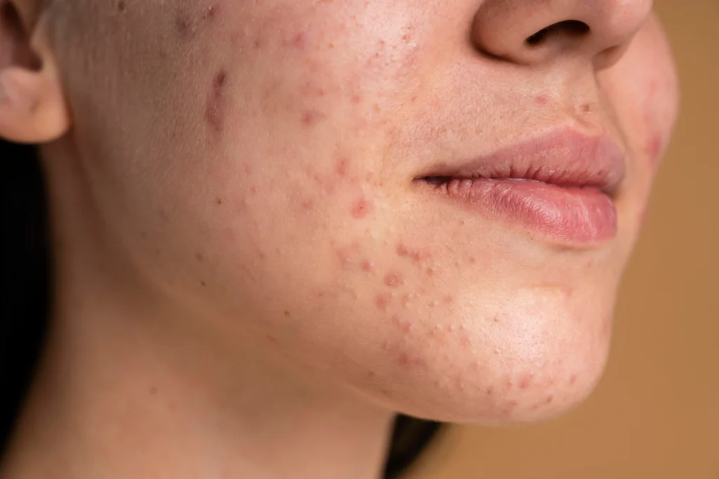 Q young lady with dark spots on her face and confidently smiling